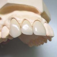Large picture Dental Porcelain Pure Titanium crown