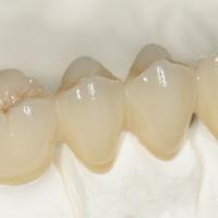 Large picture Dental Captak crown teeth restoration