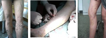 asthetic laser for varicose vein