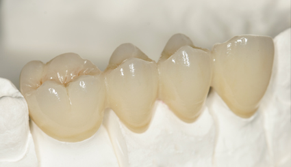 Dental Captak crown teeth restoration