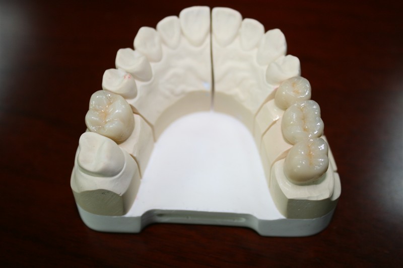 Dental IPS E.max all ceramic Crown and bridge